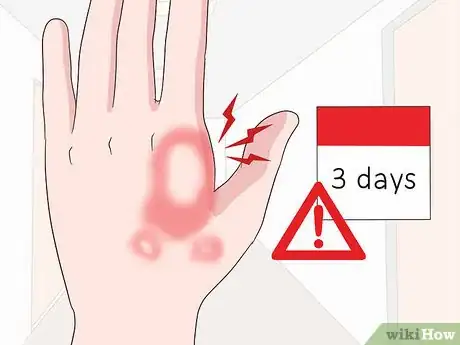 Imagen titulada Reduce Bug Bite Swelling Step 15