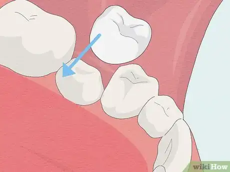 Imagen titulada Fix Rotting Teeth Step 4