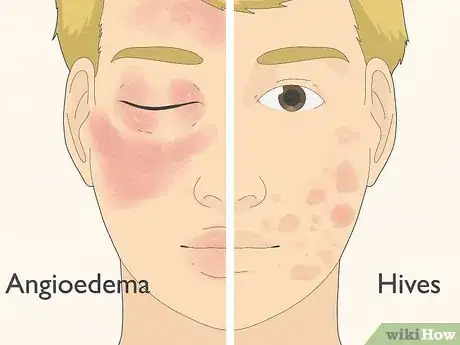 Imagen titulada Recognize Hives (Rash) Step 4