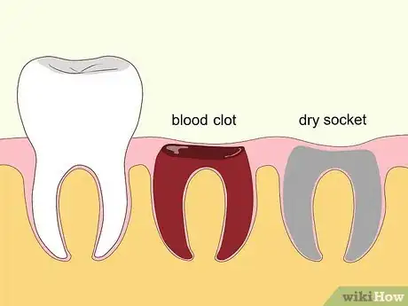 Imagen titulada Relieve Dry Socket Step 1