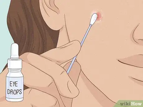 Imagen titulada Get Rid of a Zit Overnight Step 9