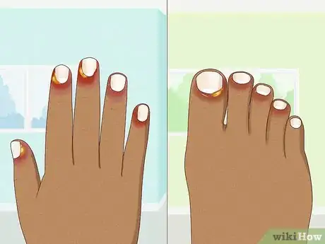 Imagen titulada Stop Itchy Cuticles Step 2