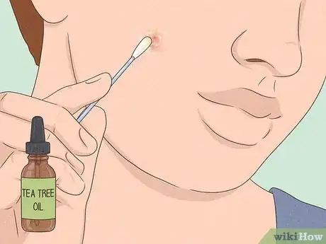 Imagen titulada Get Rid of a Zit Overnight Step 4