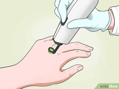 Imagen titulada Get Rid of Warts on Hands Step 12