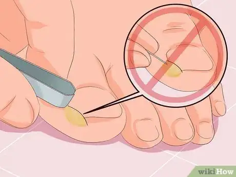 Imagen titulada Remove Infection from an Ingrown Toenail Step 6