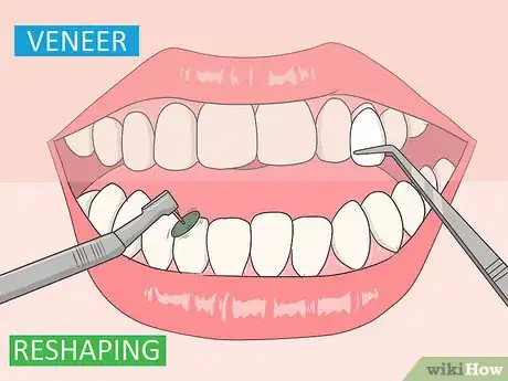 Imagen titulada Fix an Underbite Step 9