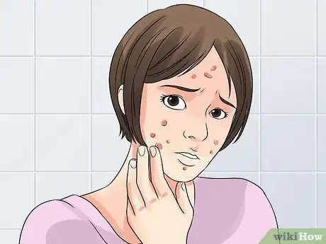 Imagen titulada Decrease the Size of a Pimple Overnight Step 6
