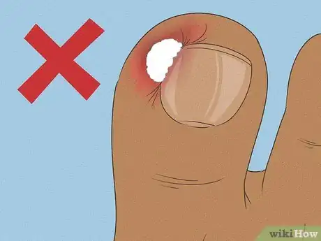 Imagen titulada Will an Ingrown Toenail Heal Itself Step 6