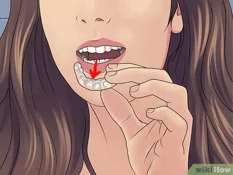 Imagen titulada Get Straight Teeth Without Braces with Invisalign Step 12