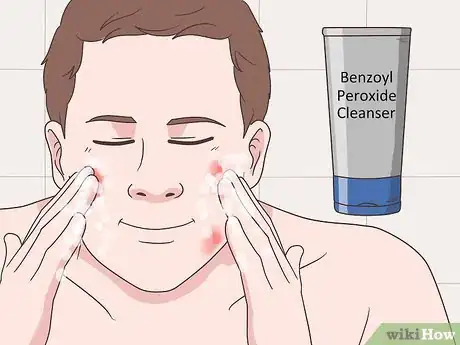 Imagen titulada Get Rid of Acne Cysts Fast Step 8