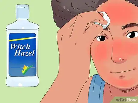 Imagen titulada Treat a Severe Sunburn Step 10