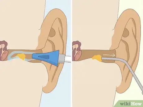 Imagen titulada Prevent Earwax Buildup Step 11