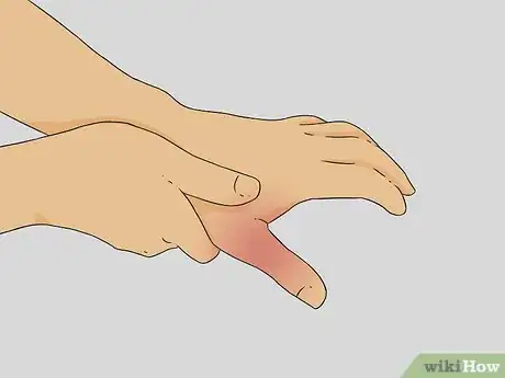 Imagen titulada Diagnose a Broken Thumb Step 1