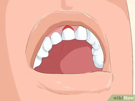 Imagen titulada Pull Out a Tooth Step 12