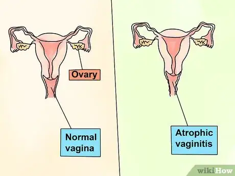 Imagen titulada Treat Vaginitis Step 13