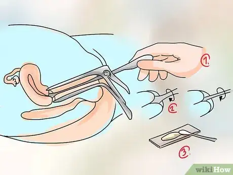 Imagen titulada Treat Vaginitis Step 11