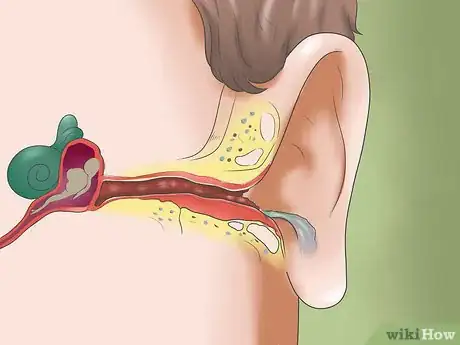 Imagen titulada Cure an Ear Infection Step 2