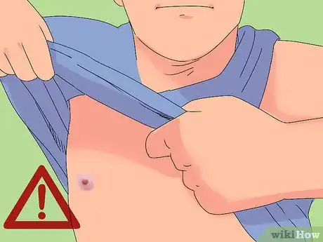 Imagen titulada Treat a Severe Sunburn Step 12