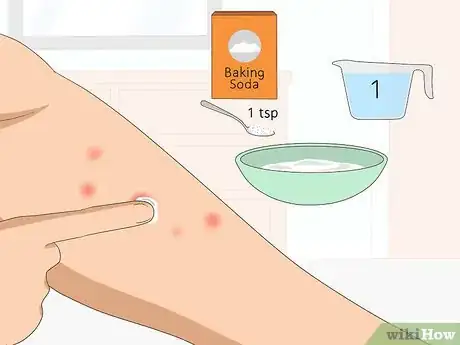 Imagen titulada Heal Mosquito Bites Fast Step 6