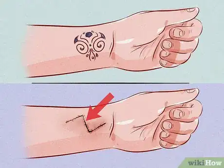 Imagen titulada Remove a Tattoo Step 5