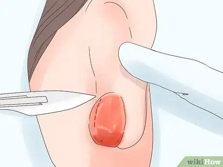 Imagen titulada Treat an Infected Ear Piercing Step 5