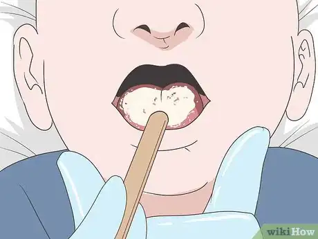 Imagen titulada Know if You Have Oral Thrush Step 9