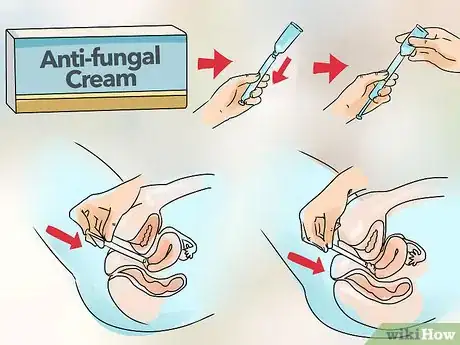 Imagen titulada Cure Vaginal Infections Without Using Medications Step 27