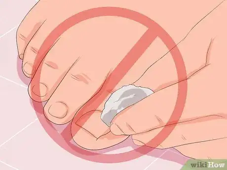 Imagen titulada Remove Infection from an Ingrown Toenail Step 9