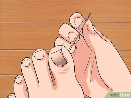 Imagen titulada Remove a Dead Toenail Step 5