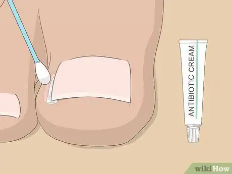 Imagen titulada Relieve Ingrown Toe Nail Pain Step 18