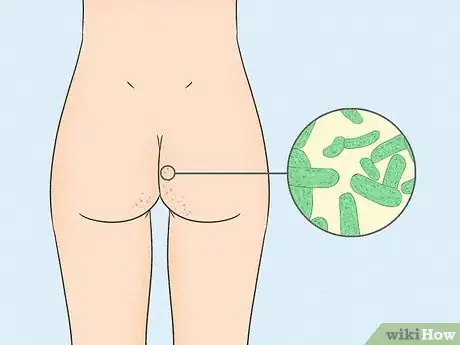 Imagen titulada Get Rid of Acne on the Buttocks Step 1