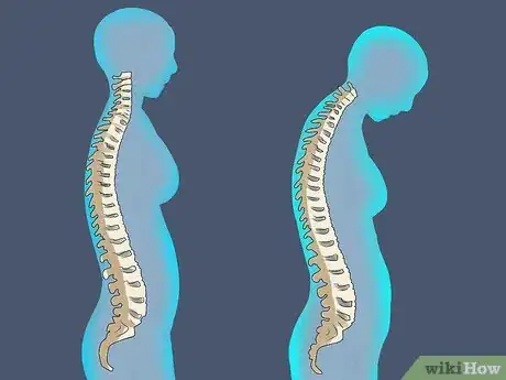 Imagen titulada Reverse Dental Bone Loss Step 15