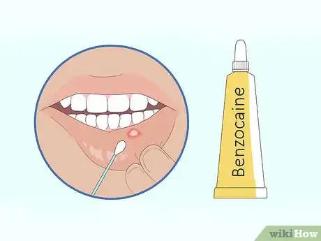 Imagen titulada Get Rid of Mouth Blisters Step 10