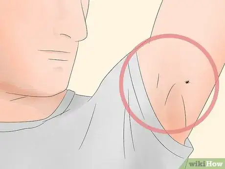 Imagen titulada Identify Tick Bites Step 1