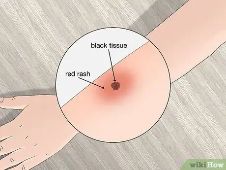 Imagen titulada Identify Tick Bites Step 6