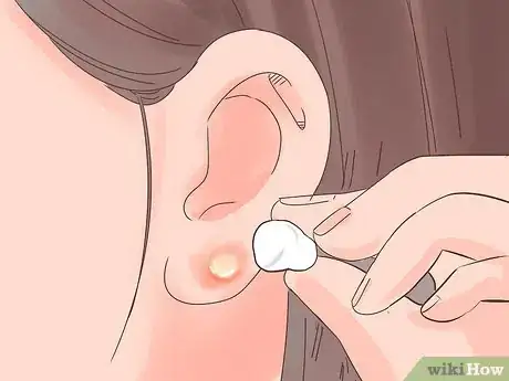 Imagen titulada Treat an Infected Ear Piercing Step 8