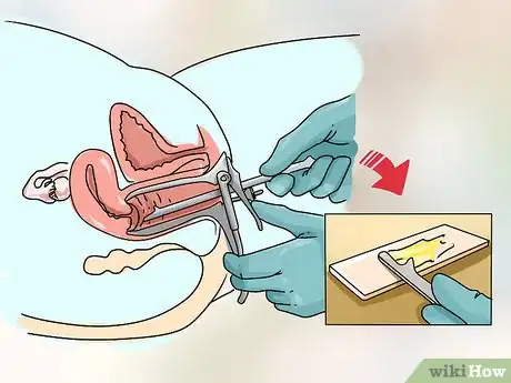 Imagen titulada Treat Vaginitis Step 1