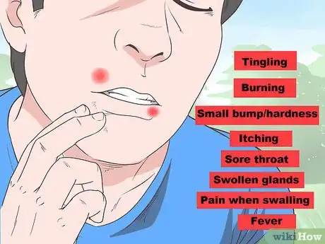 Imagen titulada Treat a Cold Sore or Fever Blisters Step 2
