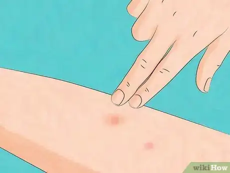 Imagen titulada Stop Bed Bug Bites Immediately Step 14