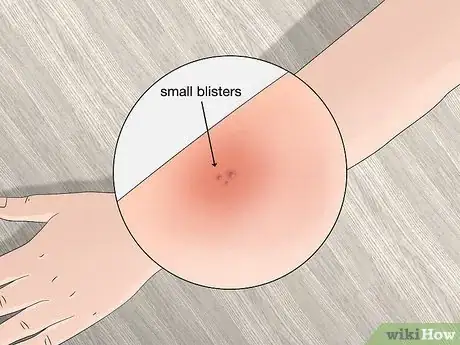 Imagen titulada Identify Tick Bites Step 8