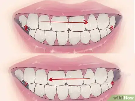 Imagen titulada Stop Grinding Teeth at Night Step 1