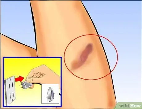 Imagen titulada Use Aloe Vera to Treat Burns Step 1