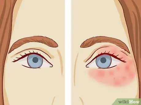 Imagen titulada Treat Eczema Around the Eyes Step 3