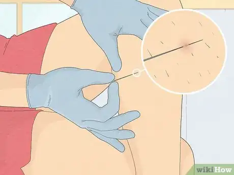 Imagen titulada Remove an Ingrown Hair Under the Skin Step 8