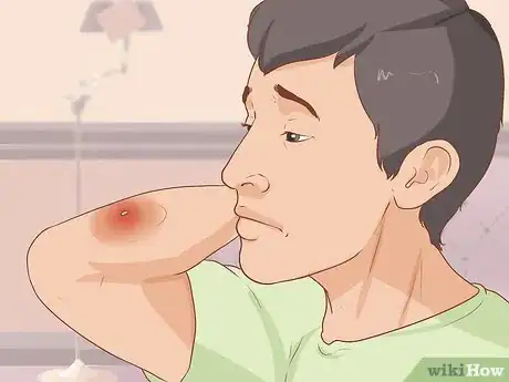 Imagen titulada Take Care of a Wasp Sting Step 10