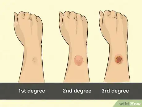 Imagen titulada Use Aloe Vera to Treat Burns Step 2