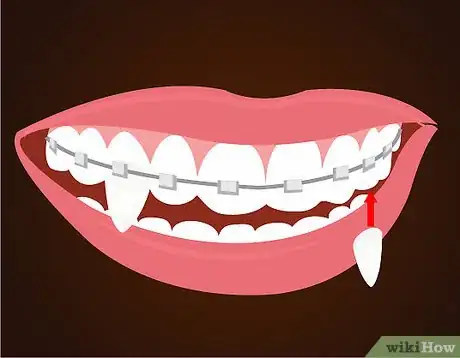 Imagen titulada Make Vampire Fangs if You Have Braces Step 11