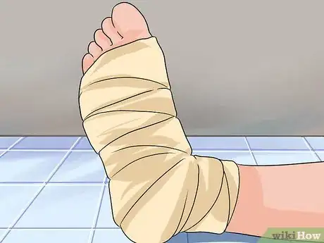 Imagen titulada Tape a Foot for Plantar Fasciitis Step 5
