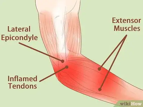 Imagen titulada Heal a Sore Arm Step 5