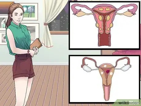 Imagen titulada Treat Vaginal Cysts Step 1